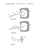 Devices, Systems and Methods for Treating Disorders of the Ear, Nose and     Throat diagram and image