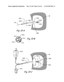 Devices, Systems and Methods for Treating Disorders of the Ear, Nose and     Throat diagram and image