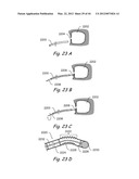 Devices, Systems and Methods for Treating Disorders of the Ear, Nose and     Throat diagram and image