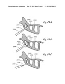 Devices, Systems and Methods for Treating Disorders of the Ear, Nose and     Throat diagram and image