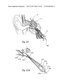 Devices, Systems and Methods for Treating Disorders of the Ear, Nose and     Throat diagram and image