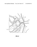SOLUBLE MATERIAL INSERTION AID FOR BALLOON CATHETER diagram and image