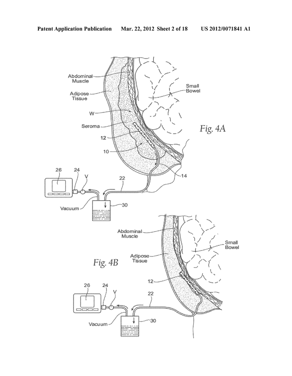 ASSEMBLIES, SYSTEMS, AND METHODS FOR VACUUM ASSISTED INTERNAL DRAINAGE     DURING WOUND HEALING - diagram, schematic, and image 03