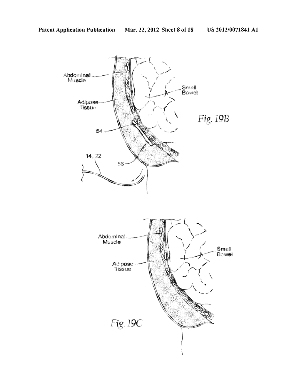 ASSEMBLIES, SYSTEMS, AND METHODS FOR VACUUM ASSISTED INTERNAL DRAINAGE     DURING WOUND HEALING - diagram, schematic, and image 09