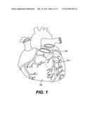 ENDOVASCULAR DEVICES AND METHODS diagram and image