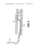 ENDOVASCULAR DEVICES AND METHODS diagram and image