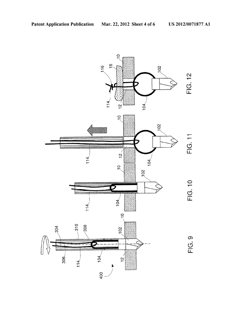 Device for Anchoring a Suture - diagram, schematic, and image 05