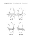 PATIENT SELECTABLE JOINT ARTHROPLASTY DEVICES AND SURGICAL TOOLS diagram and image