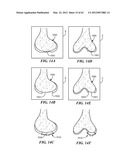 PATIENT SELECTABLE JOINT ARTHROPLASTY DEVICES AND SURGICAL TOOLS diagram and image