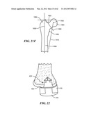 PATIENT SELECTABLE JOINT ARTHROPLASTY DEVICES AND SURGICAL TOOLS diagram and image