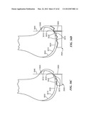 PATIENT SELECTABLE JOINT ARTHROPLASTY DEVICES AND SURGICAL TOOLS diagram and image