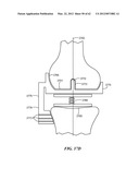 PATIENT SELECTABLE JOINT ARTHROPLASTY DEVICES AND SURGICAL TOOLS diagram and image