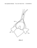 PATIENT SELECTABLE JOINT ARTHROPLASTY DEVICES AND SURGICAL TOOLS diagram and image