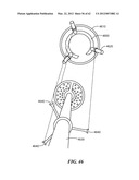 PATIENT SELECTABLE JOINT ARTHROPLASTY DEVICES AND SURGICAL TOOLS diagram and image