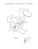 PATIENT SELECTABLE JOINT ARTHROPLASTY DEVICES AND SURGICAL TOOLS diagram and image