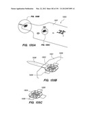 ANTI-BUCKLING MECHANISMS AND METHODS diagram and image