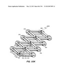 ANTI-BUCKLING MECHANISMS AND METHODS diagram and image