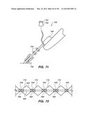 ANTI-BUCKLING MECHANISMS AND METHODS diagram and image