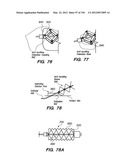 ANTI-BUCKLING MECHANISMS AND METHODS diagram and image