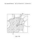 SYSTEM FOR PROVIDING SURGICAL ACCESS diagram and image