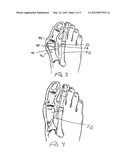 METHODS AND DEVICES FOR TREATING HALLUX VALGUS diagram and image