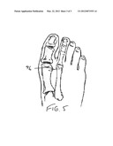 METHODS AND DEVICES FOR TREATING HALLUX VALGUS diagram and image