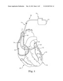 SELECTIVELY CONNECTING THE TIP ELECTRODE DURING THERAPY FOR MRI SHIELDING diagram and image