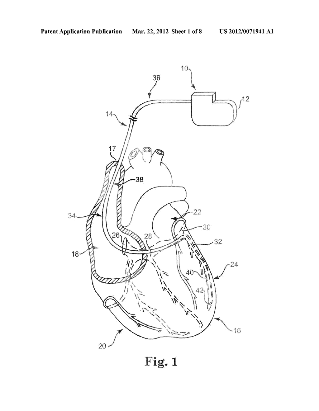 SELECTIVELY CONNECTING THE TIP ELECTRODE DURING THERAPY FOR MRI SHIELDING - diagram, schematic, and image 02