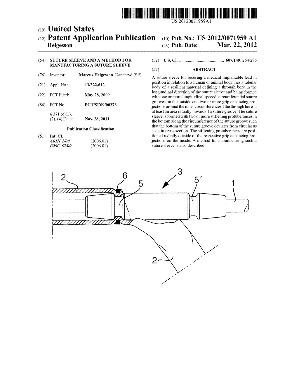 SUTURE SLEEVE AND A METHOD FOR MANUFACTURING A SUTURE SLEEVE - diagram, schematic, and image 01