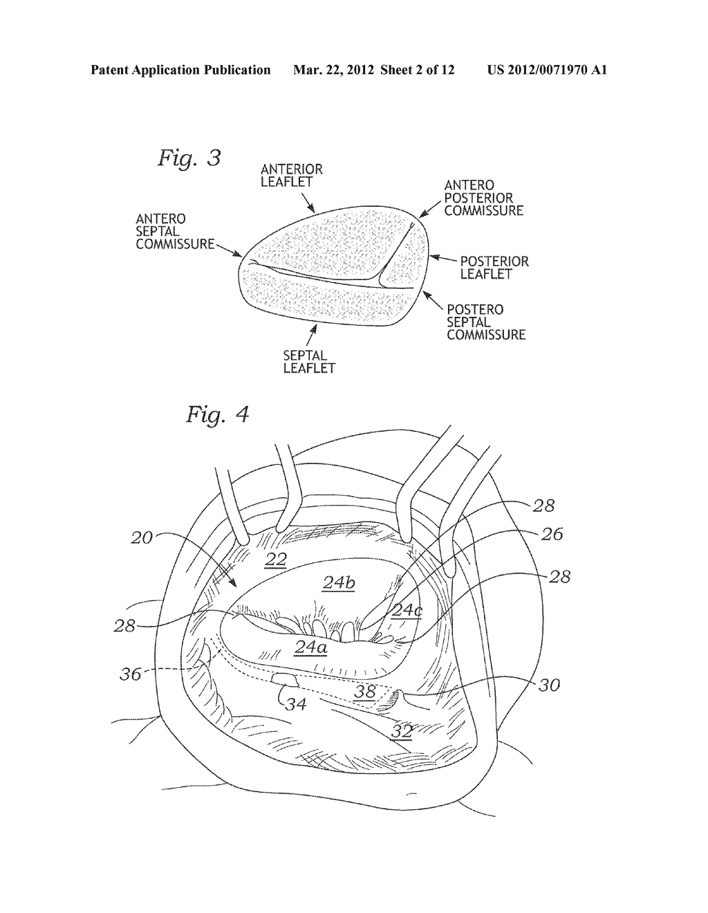 PHYSIOLOGIC TRICUSPID ANNULOPLASTY RING - diagram, schematic, and image 03