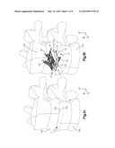 DISTRACTIBLE INTERVERTEBRAL IMPLANT diagram and image