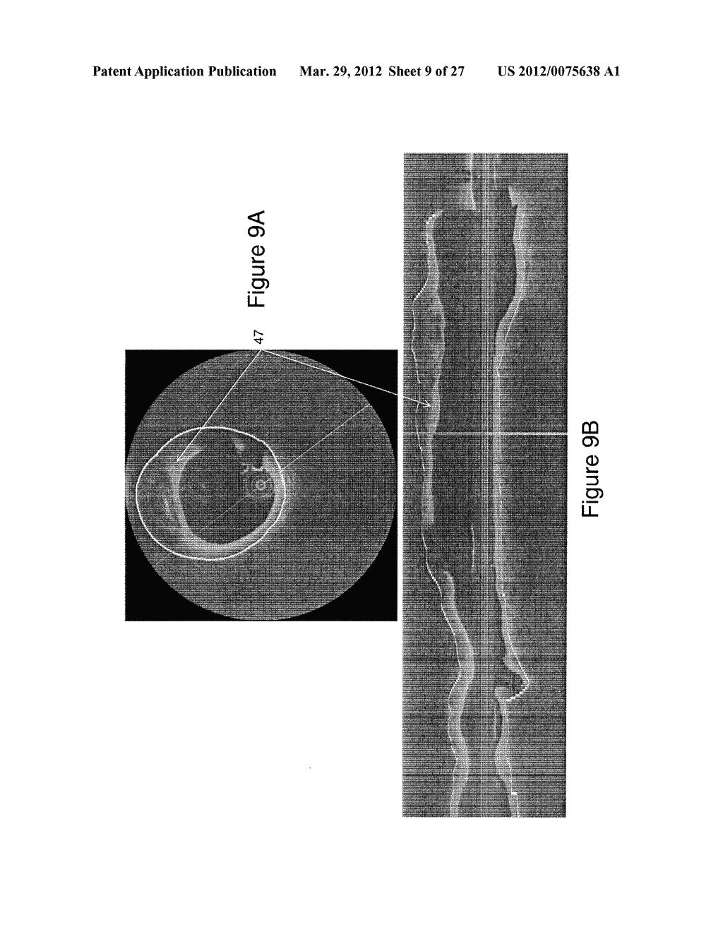 SEGMENTATION AND QUANTIFICATION FOR INTRAVASCULAR OPTICAL COHERENCE     TOMOGRAPHY IMAGES - diagram, schematic, and image 10