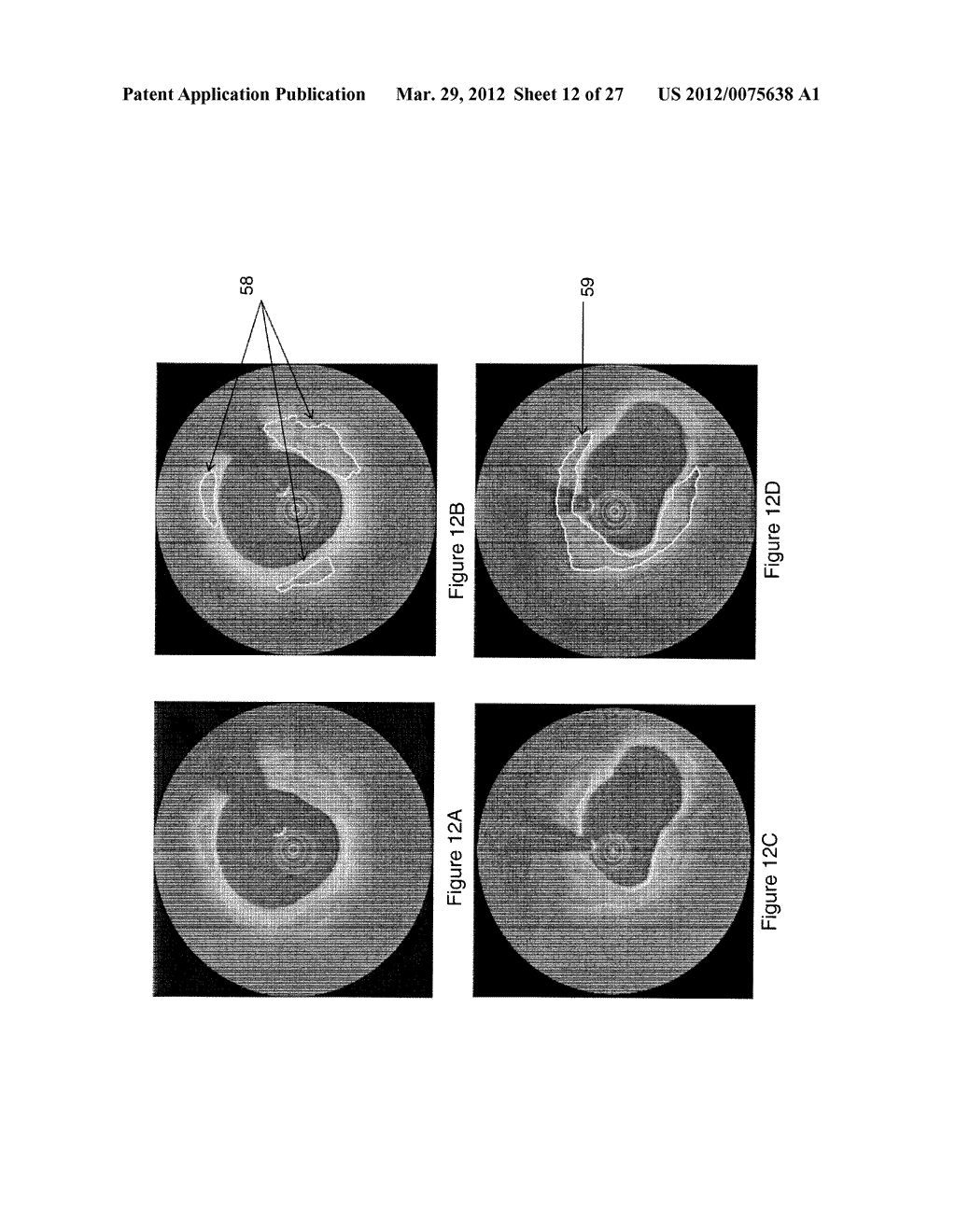 SEGMENTATION AND QUANTIFICATION FOR INTRAVASCULAR OPTICAL COHERENCE     TOMOGRAPHY IMAGES - diagram, schematic, and image 13