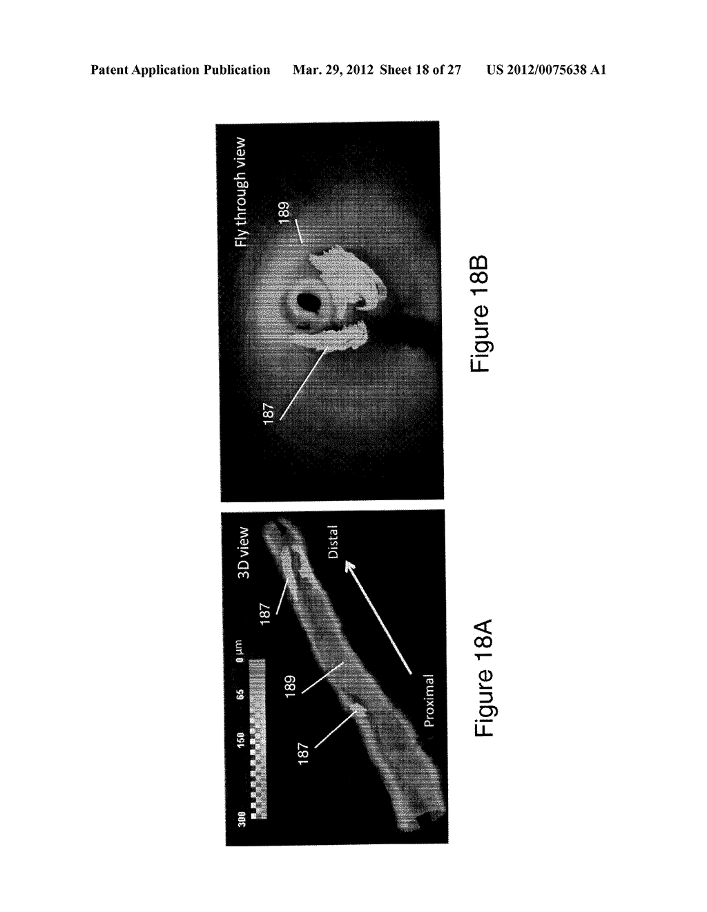 SEGMENTATION AND QUANTIFICATION FOR INTRAVASCULAR OPTICAL COHERENCE     TOMOGRAPHY IMAGES - diagram, schematic, and image 19