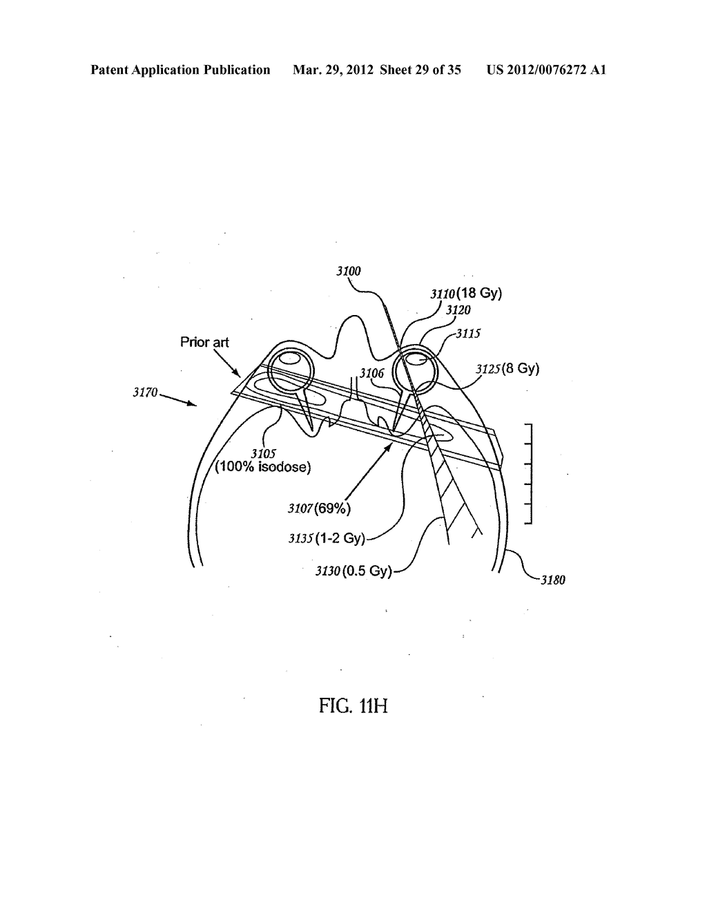OCULAR RADIOSURGERY - diagram, schematic, and image 30