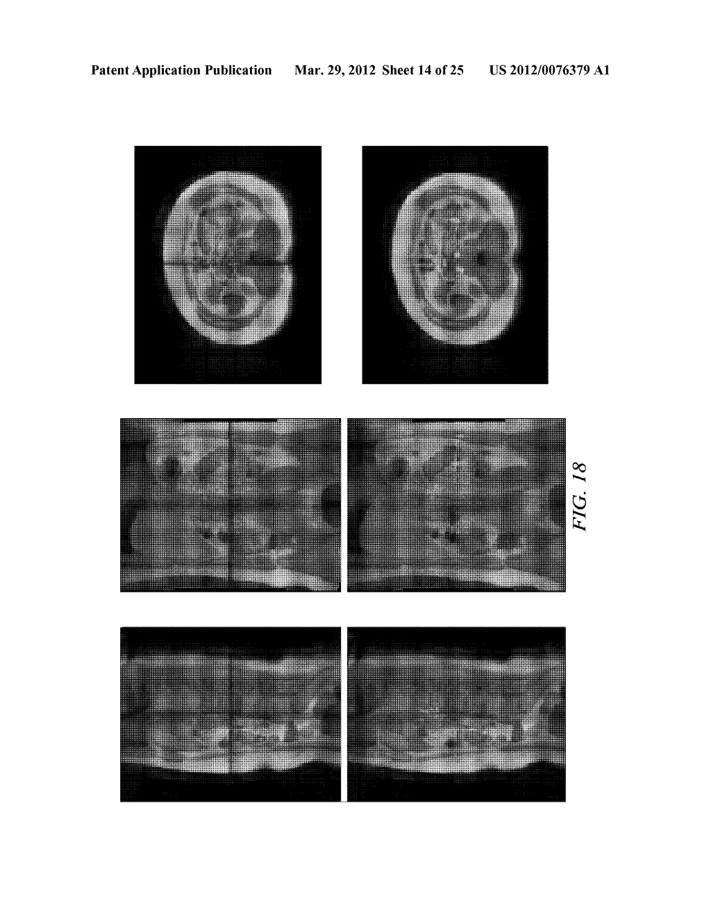 CORRECTION OF SATURATION BANDING ARTIFACTS IN MAGNETIC RESONANCE IMAGING - diagram, schematic, and image 15