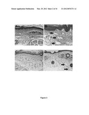 Lymphedema associated genes and model diagram and image