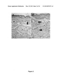 Lymphedema associated genes and model diagram and image