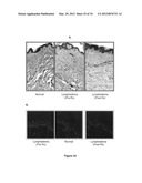 Lymphedema associated genes and model diagram and image