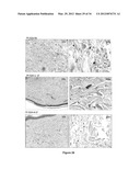 Lymphedema associated genes and model diagram and image