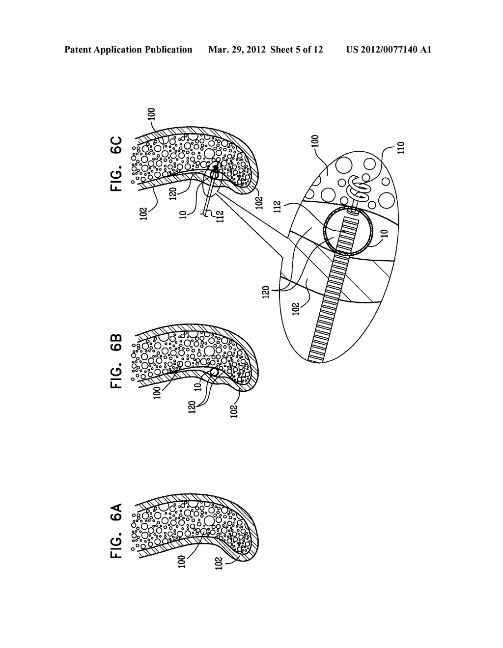 PERIOSTEAL MESHER - diagram, schematic, and image 06