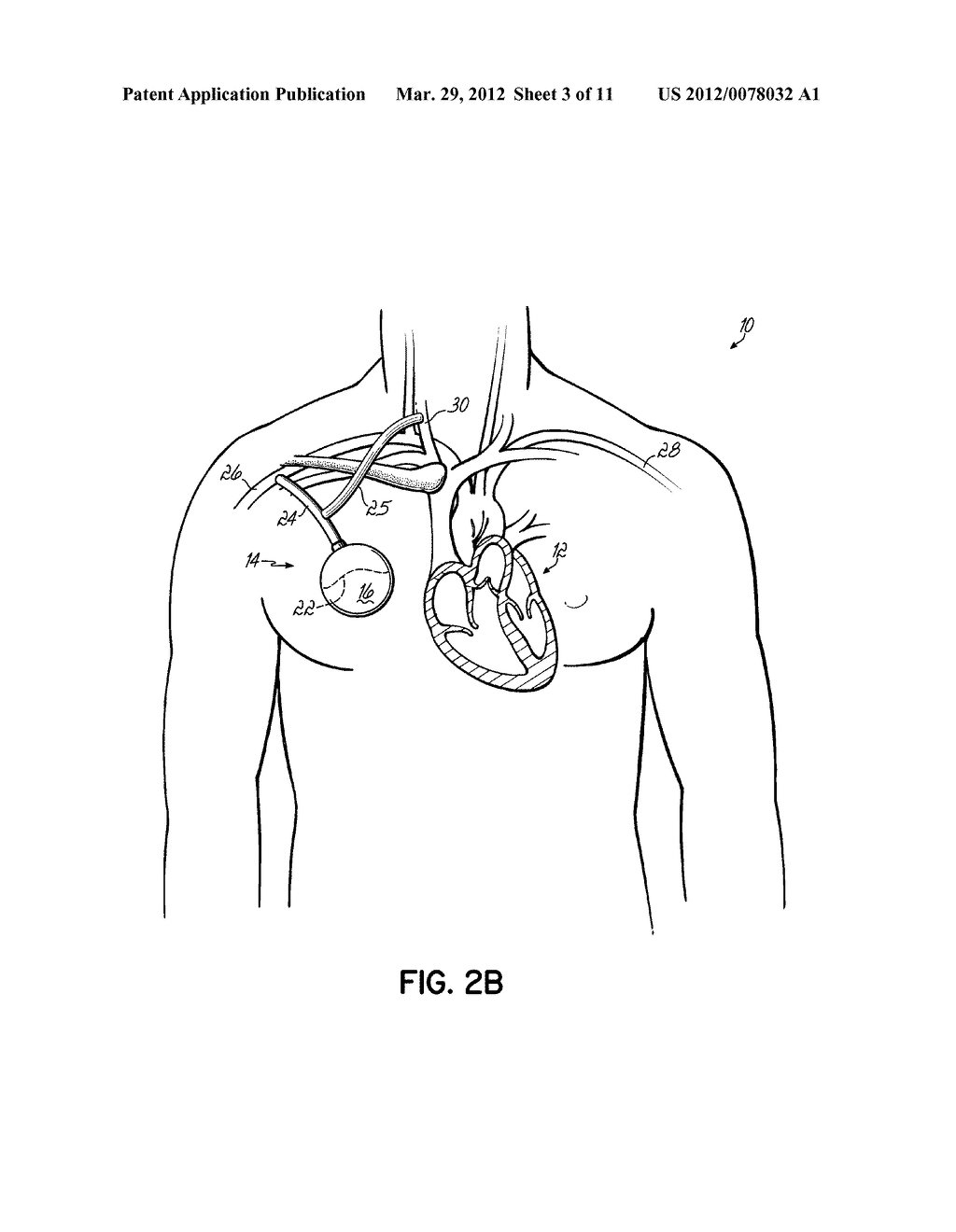 METHODS, DEVICES AND SYSTEMS FOR COUNTERPULSATION OF BLOOD FLOW TO AND     FROM THE CIRCULATORY SYSTEM - diagram, schematic, and image 04