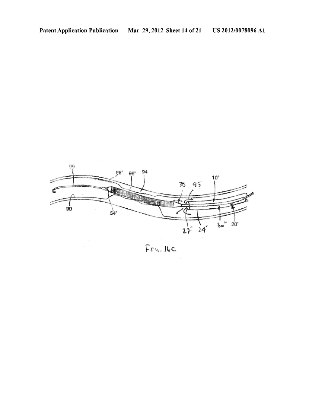 APPARATUS AND METHODS FOR TREATING OBSTRUCTIONS WITHIN BODY LUMENS - diagram, schematic, and image 15