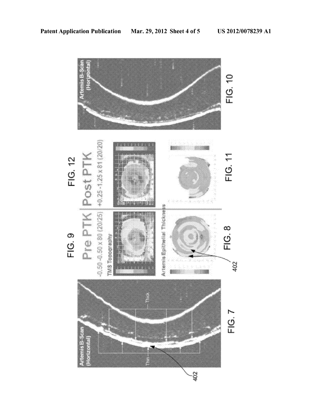 METHOD FOR INCREASING OCULAR DEPTH OF FIELD - diagram, schematic, and image 05