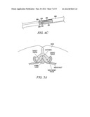 Mechanical tissue modification devices and methods diagram and image