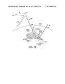 Mechanical tissue modification devices and methods diagram and image