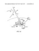 Mechanical tissue modification devices and methods diagram and image