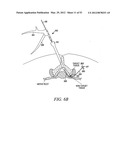 Mechanical tissue modification devices and methods diagram and image