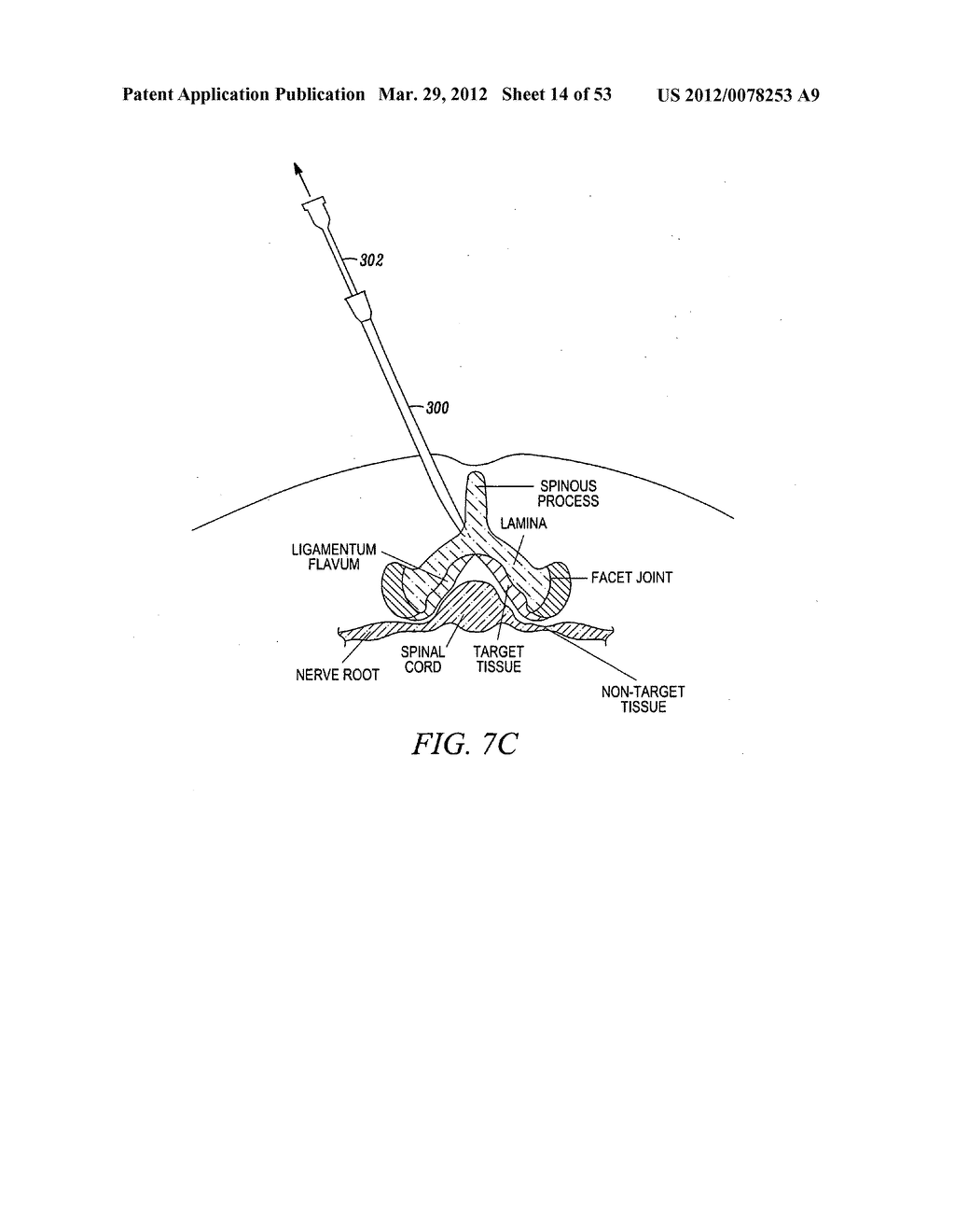 Mechanical tissue modification devices and methods - diagram, schematic, and image 15