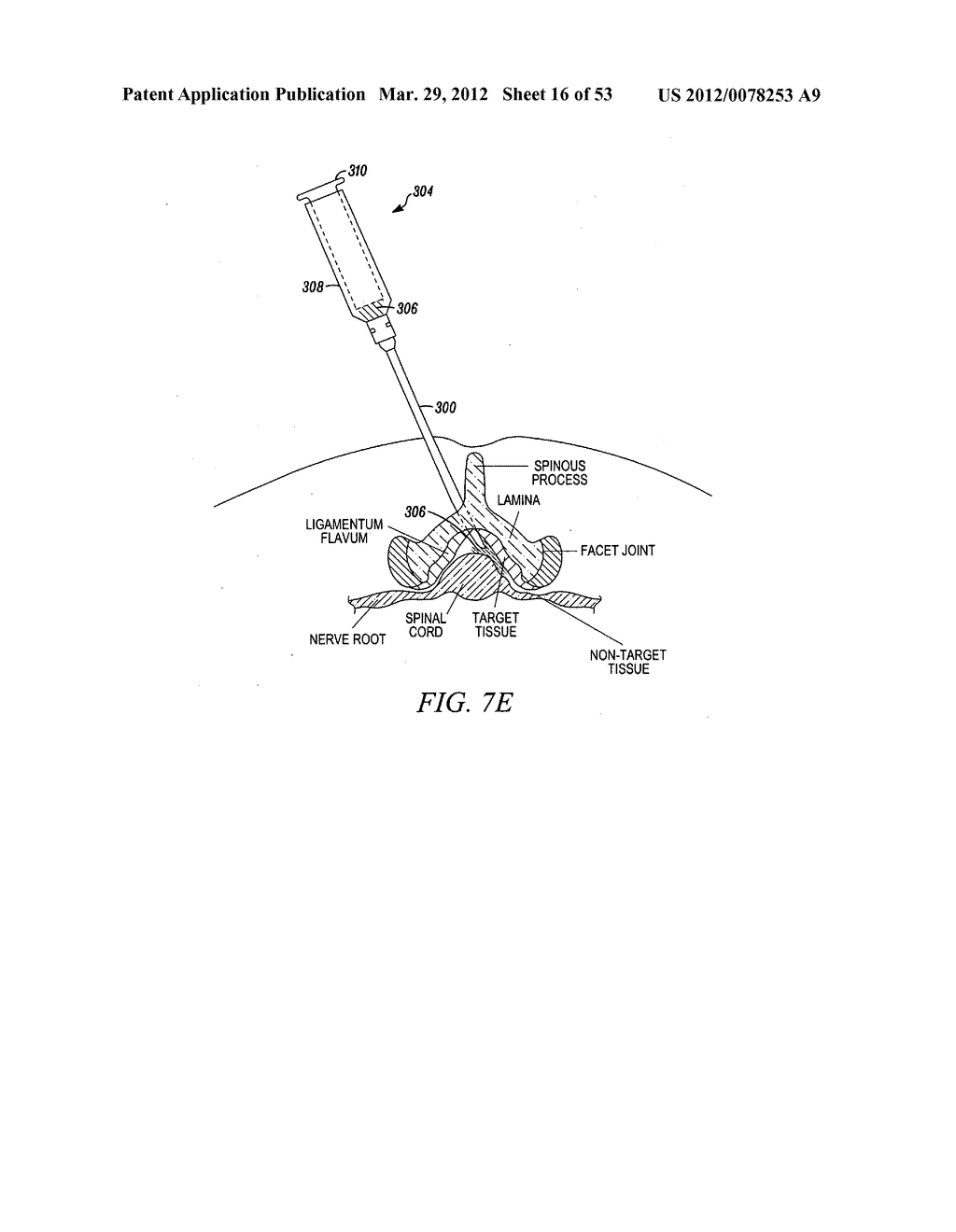 Mechanical tissue modification devices and methods - diagram, schematic, and image 17